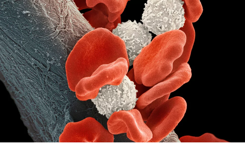 sickle cells